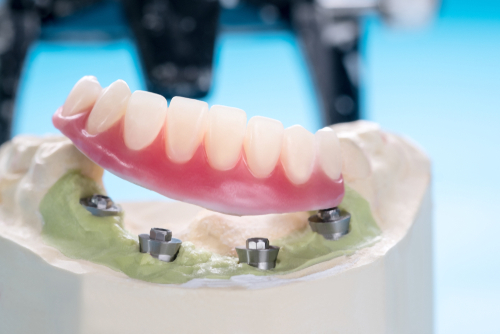 The Great Thing About Implant-Supported Dentures Versus Their Traditional Counterparts