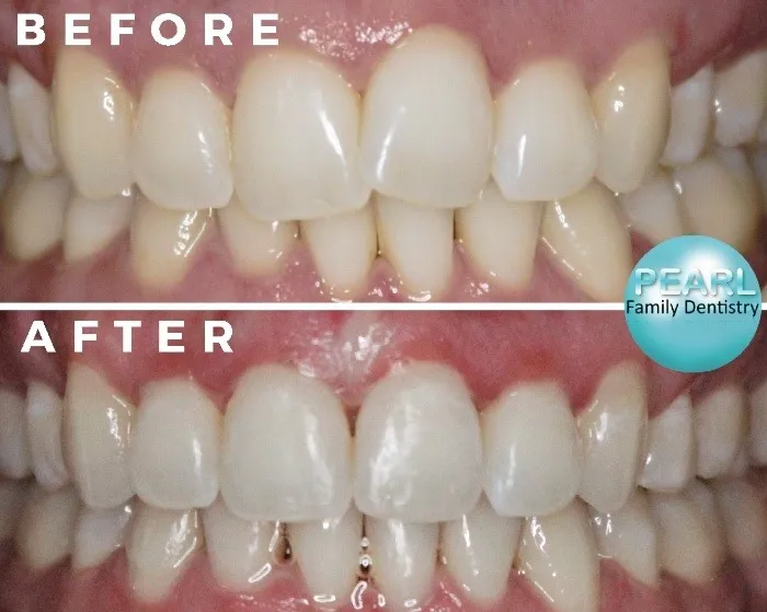 before and after image of clearcorrect aligners