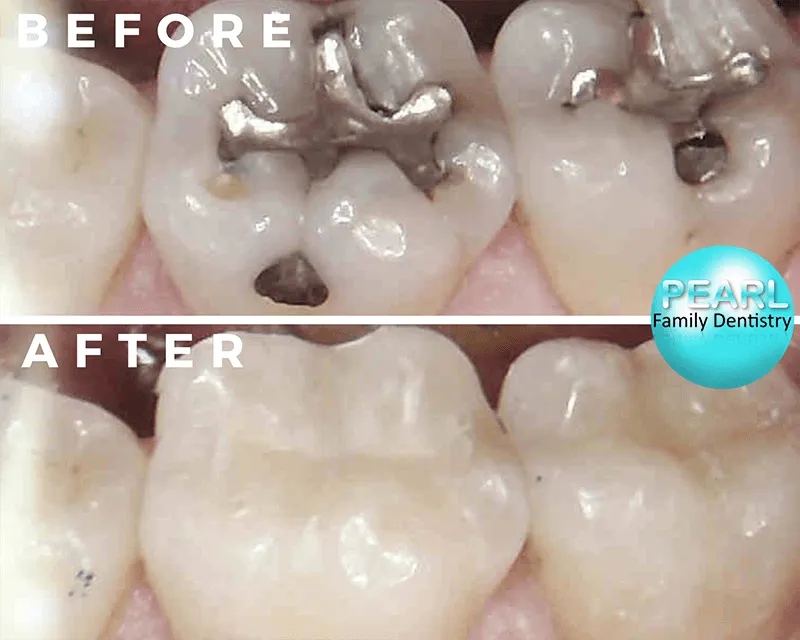 before and after image of amalgam filling replacements