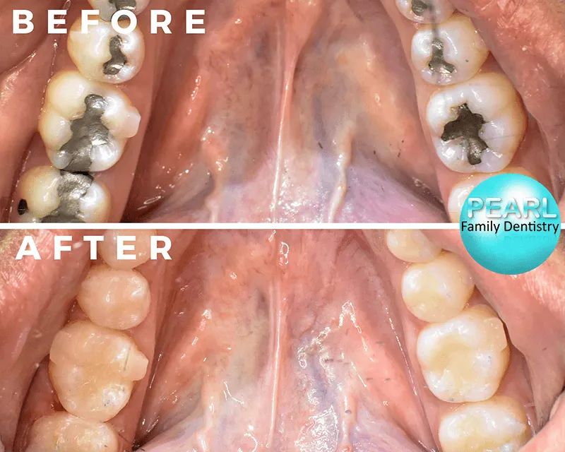 before and after image of amalgam filling replacements
