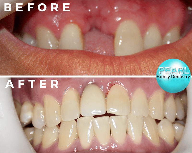before and after image of dental implants