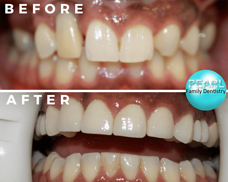 before and after image of dental implants