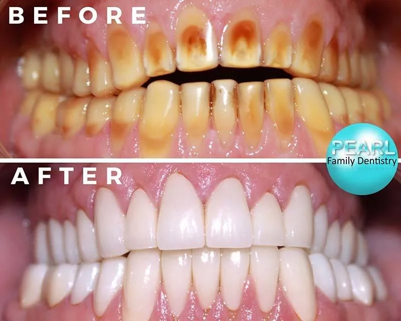 before and after image of dental crowns