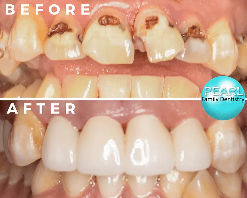 before and after image of dental crowns