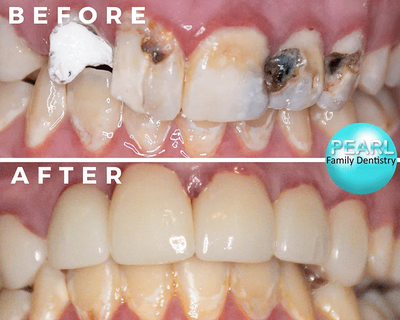 before and after image of dental crowns