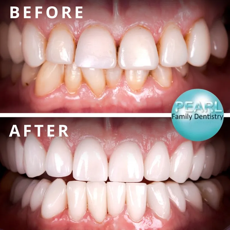 before and after image of clearcorrect aligners