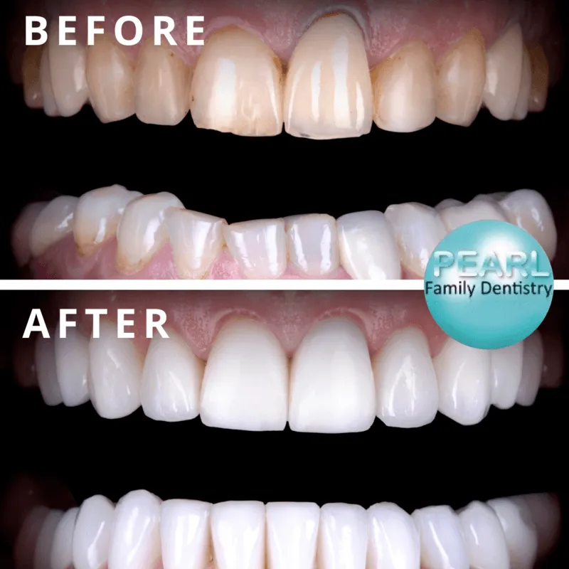 before and after image of clearcorrect aligners