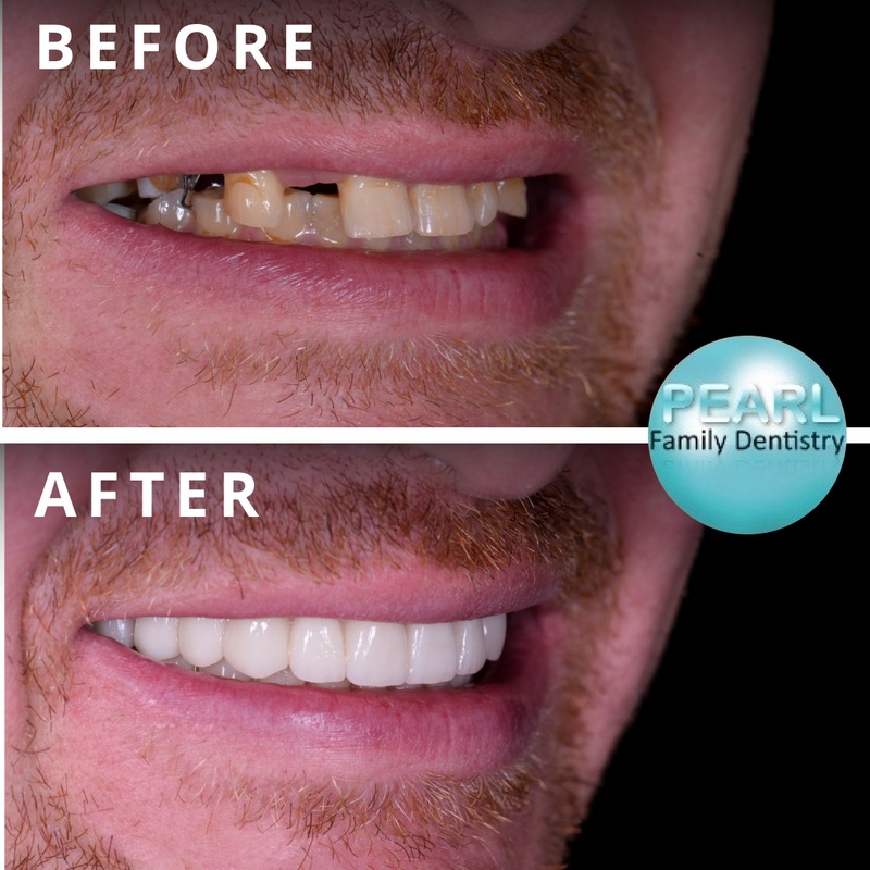before and after image of dental implants