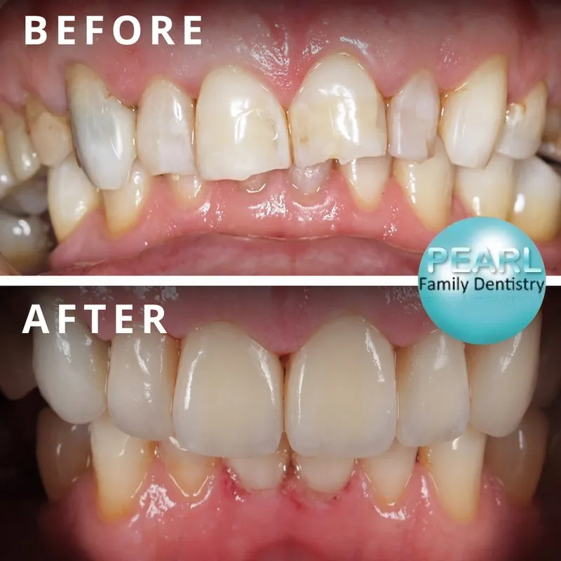 before and after image of dental crowns